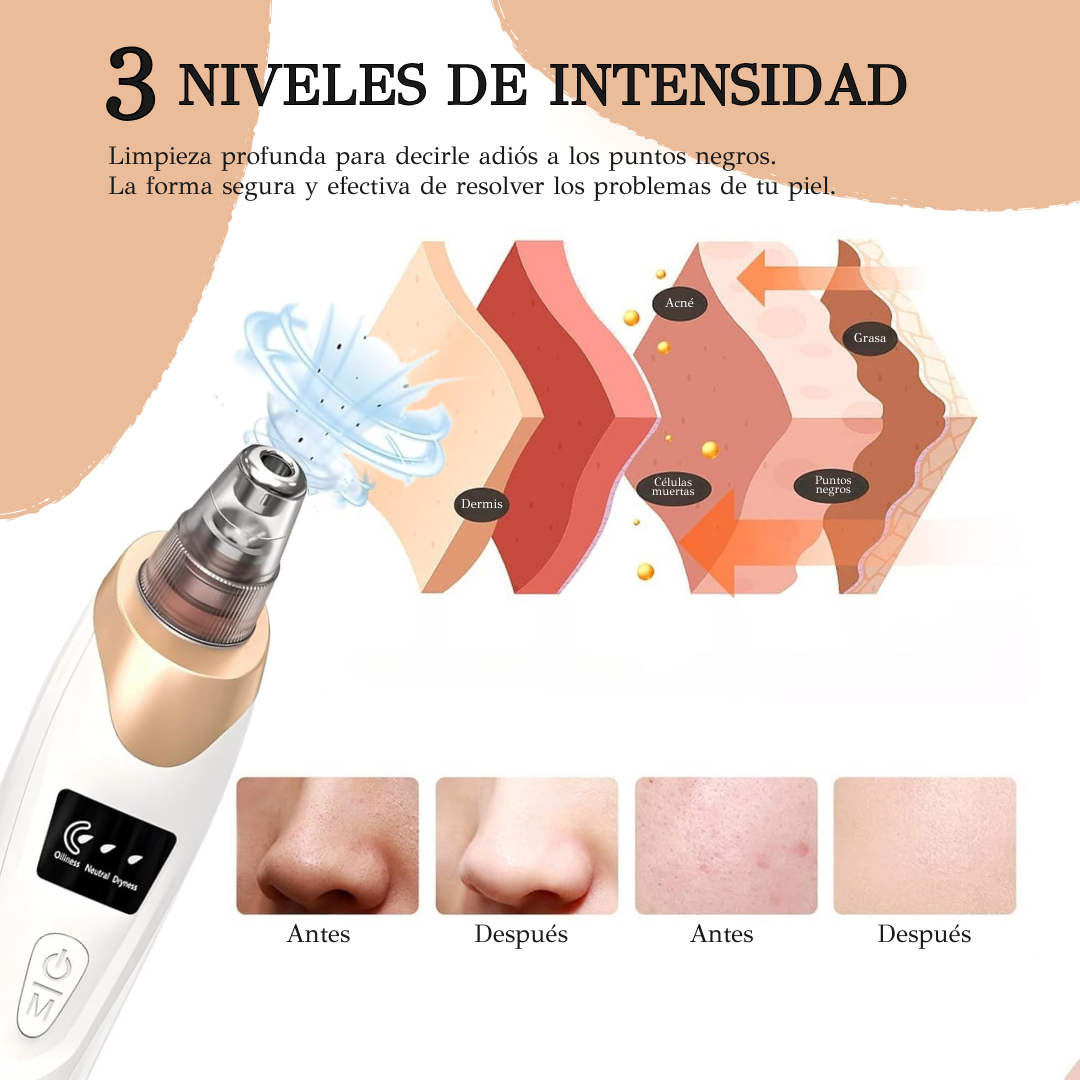 Nuvéra™ Extractor profesional de puntos negros